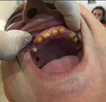 Antes - férula seccionada