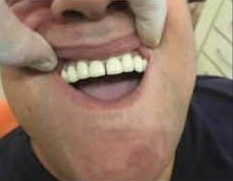 Después - férula seccionada