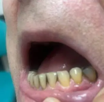 Antes - coronas inferiores