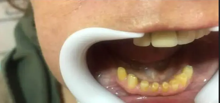 Antes - férula inferior