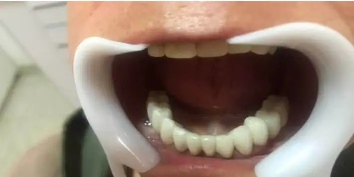 Después - férula inferior