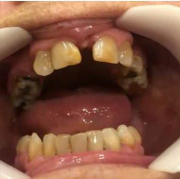 Antes - diseño y maquillaje en zirconio