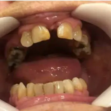 Antes - diseño en zirconio